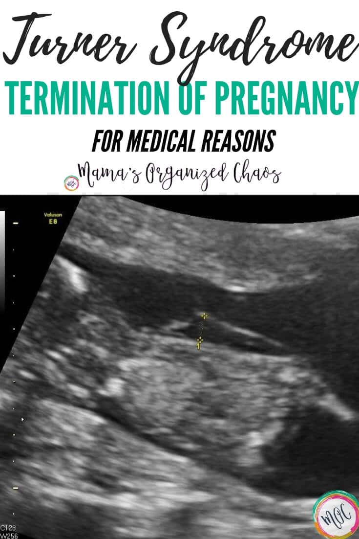 Jaide's Story Turner Syndrome Mama's Organized Chaos